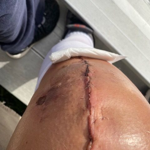 Knee Recovery with X10 Home Health