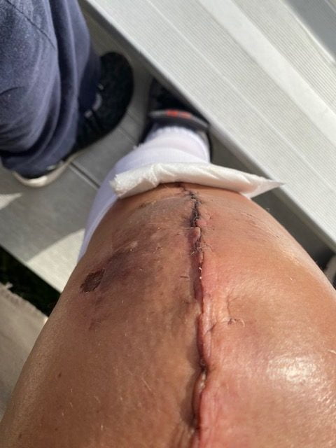 Knee Recovery with X10 Home Health Knee Recovery with X10 Home Health